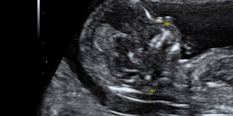 Erst Trimester Screening Vorsorge Heidelberg Frauenarzt Dr. Blumenstein