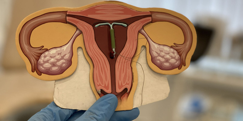 Die Hormonspiralen - Gynäkologische Vorsorgeuntersuchungen Heidelberg BahnstadtFrauenarzt Dr. Blumenstein Die Hormonspiralen - Gynäkologische Vorsorgeuntersuchungen Heidelberg BahnstadtFrauenarzt Dr. Blumenstein